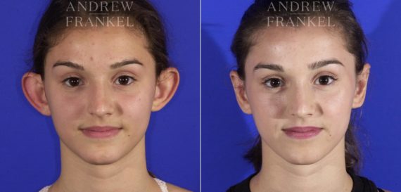 Otoplasty before and after photos in Beverly Hills, CA, Patient 3622