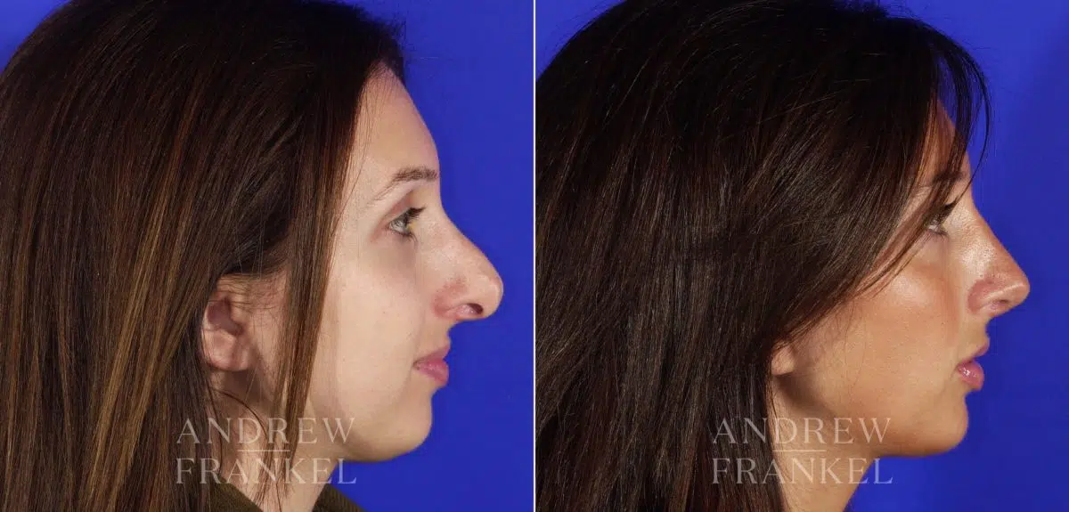 Revision Rhinoplasty before and after photos in Beverly Hills, CA, Patient 3624