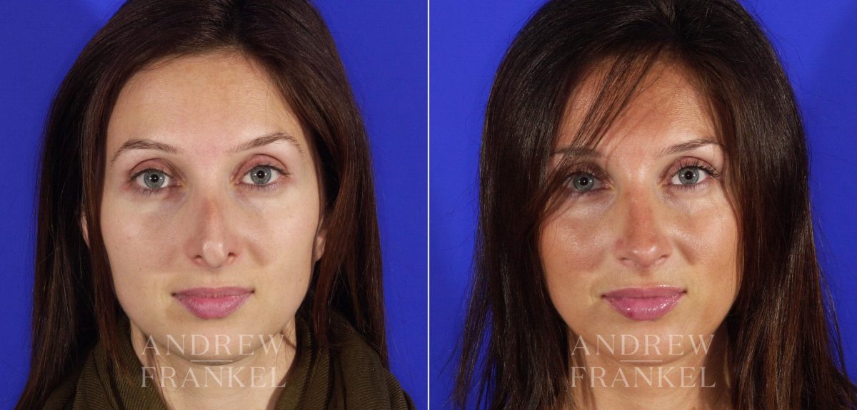 Revision Rhinoplasty before and after photos in Beverly Hills, CA, Patient 3624