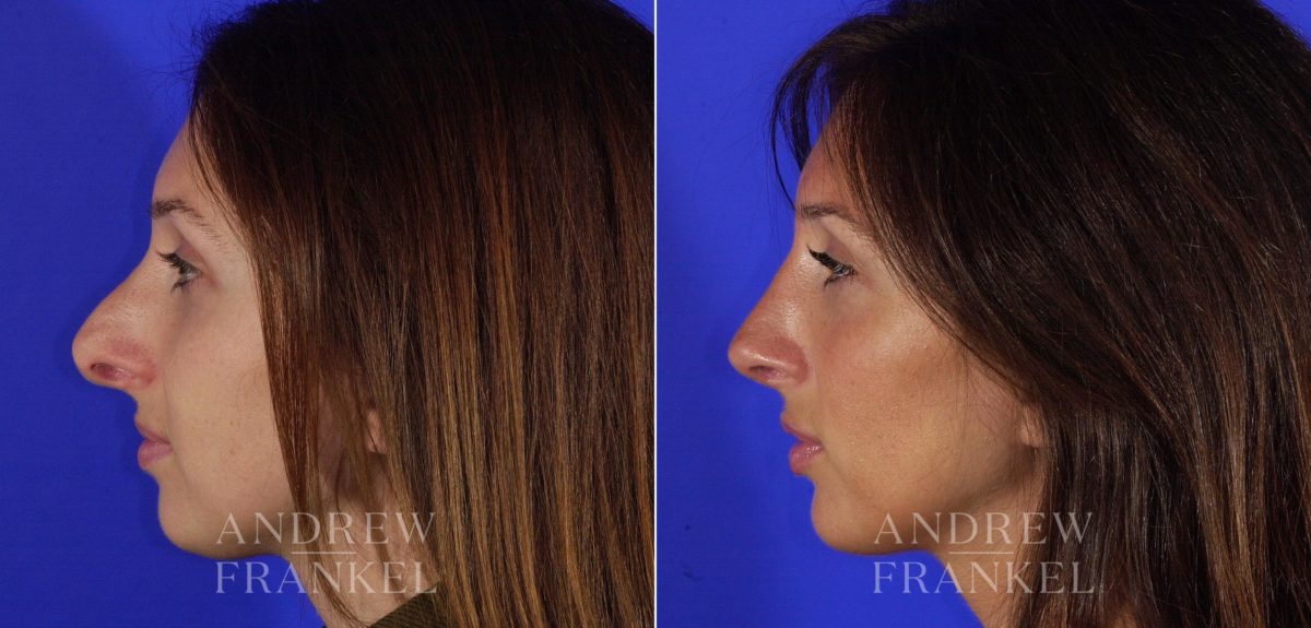 Revision Rhinoplasty before and after photos in Beverly Hills, CA, Patient 3624