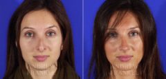 Revision Rhinoplasty before and after photos in Beverly Hills, CA, Patient 3624