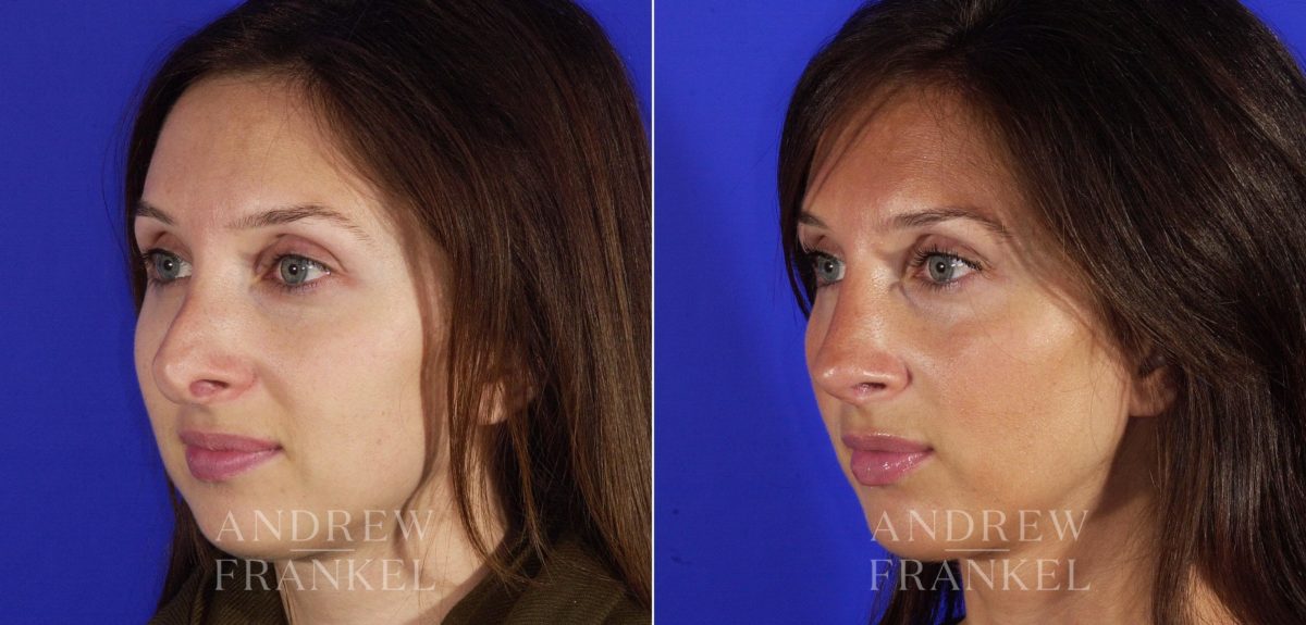 Revision Rhinoplasty before and after photos in Beverly Hills, CA, Patient 3624