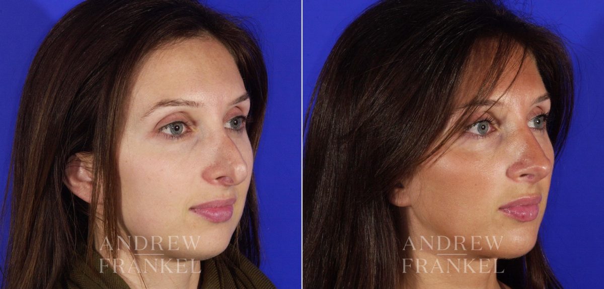 Revision Rhinoplasty before and after photos in Beverly Hills, CA, Patient 3624