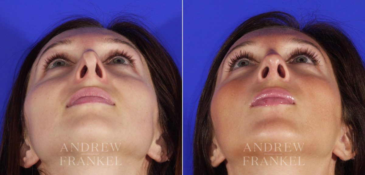 Revision Rhinoplasty before and after photos in Beverly Hills, CA, Patient 3624