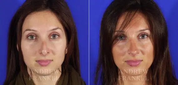Revision Rhinoplasty before and after photos in Beverly Hills, CA, Patient 3624