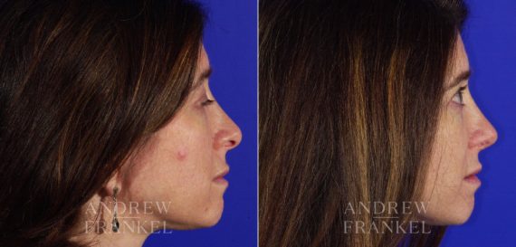 Revision Rhinoplasty before and after photos in Beverly Hills, CA, Patient 3687