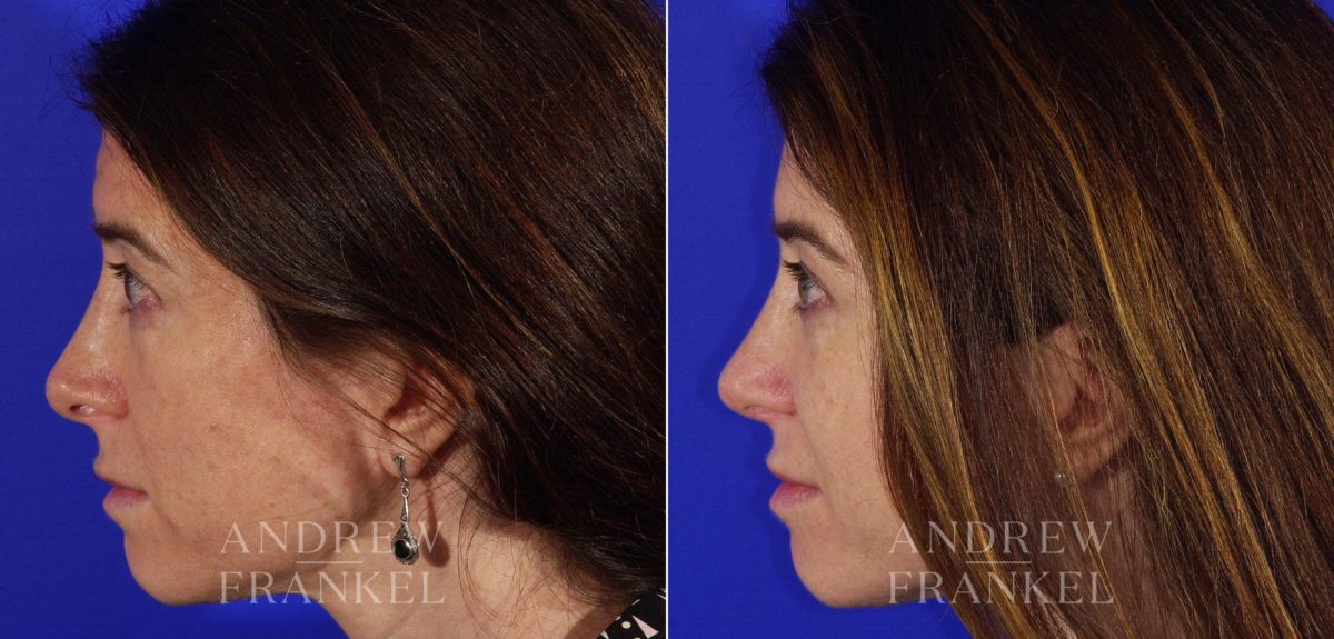 Revision Rhinoplasty before and after photos in Beverly Hills, CA, Patient 3687
