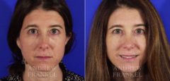 Revision Rhinoplasty before and after photos in Beverly Hills, CA, Patient 3687