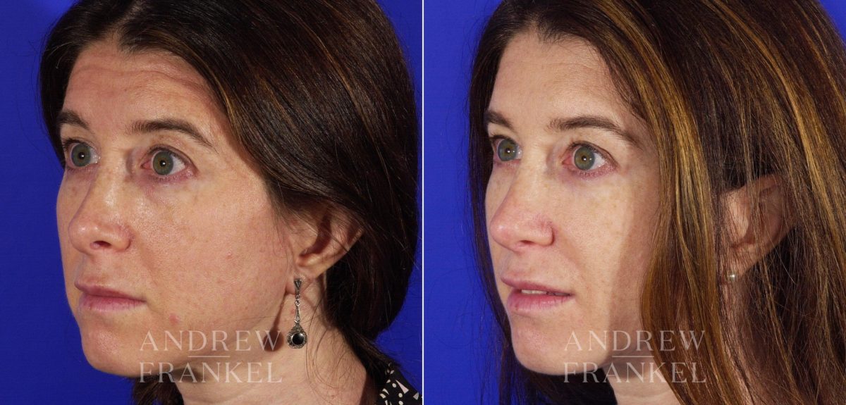 Revision Rhinoplasty before and after photos in Beverly Hills, CA, Patient 3687