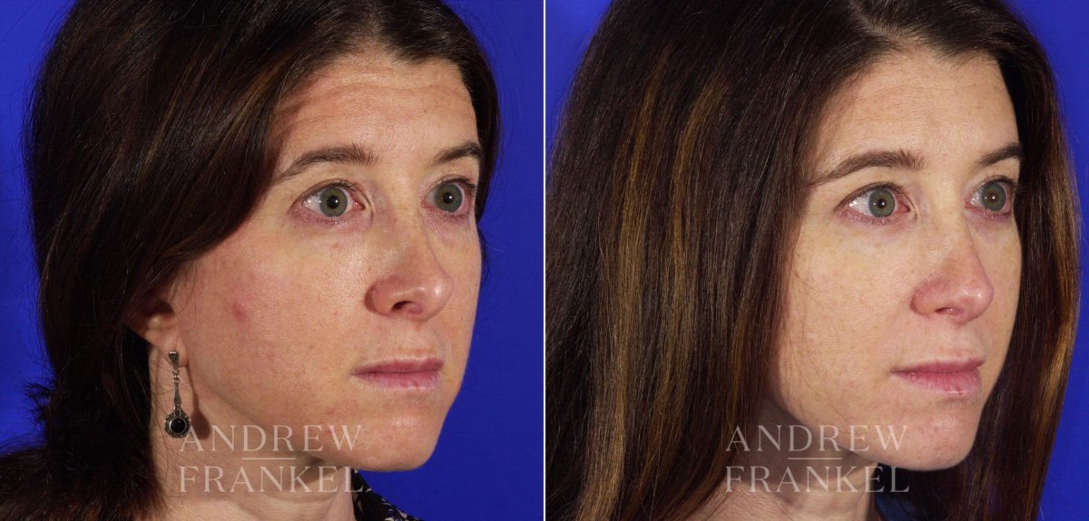Revision Rhinoplasty before and after photos in Beverly Hills, CA, Patient 3687