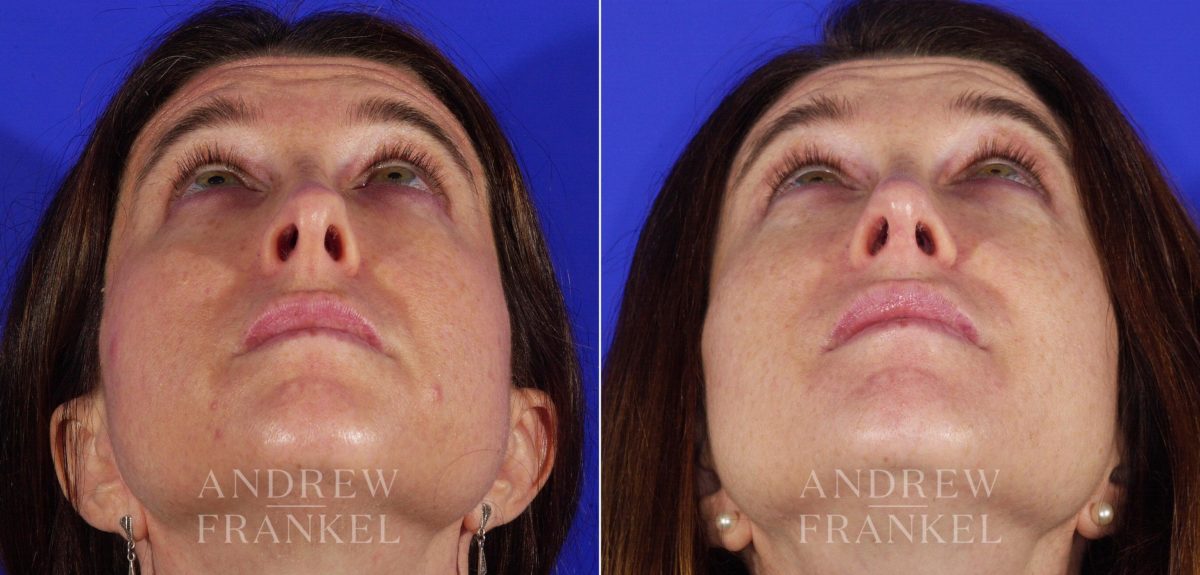 Revision Rhinoplasty before and after photos in Beverly Hills, CA, Patient 3687