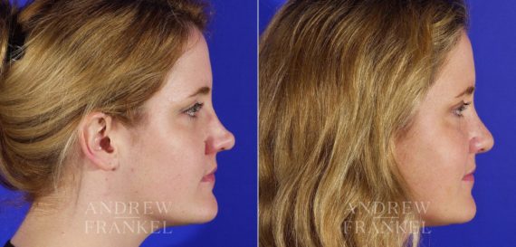 Revision Rhinoplasty before and after photos in Beverly Hills, CA, Patient 3714