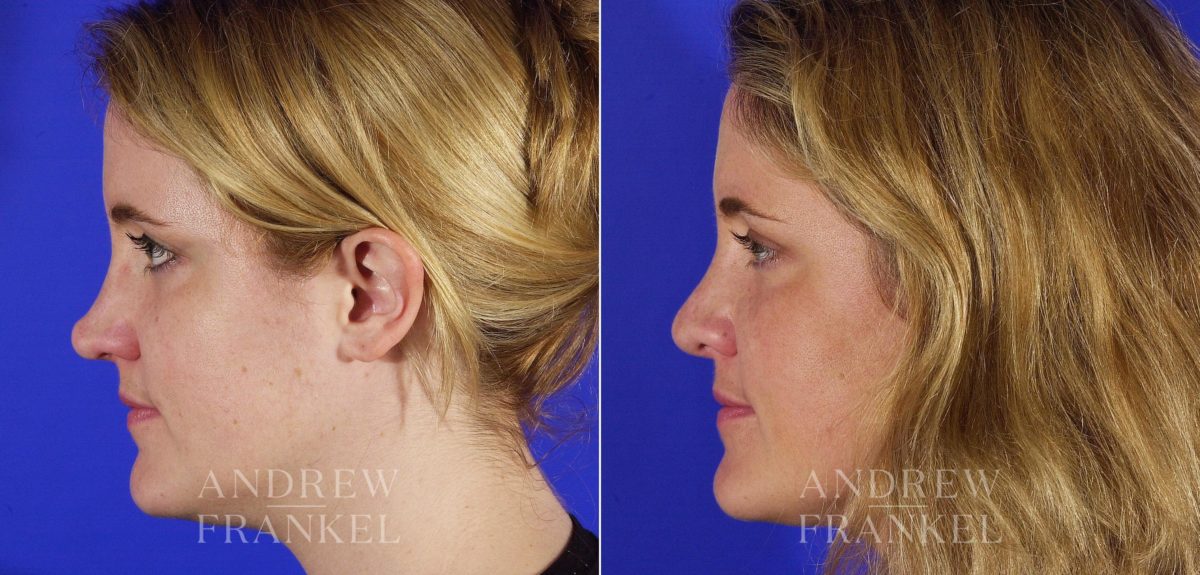 Revision Rhinoplasty before and after photos in Beverly Hills, CA, Patient 3714