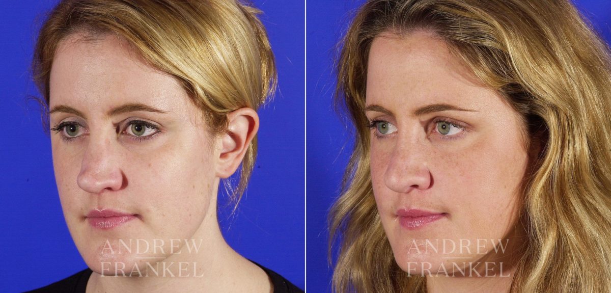 Revision Rhinoplasty before and after photos in Beverly Hills, CA, Patient 3714