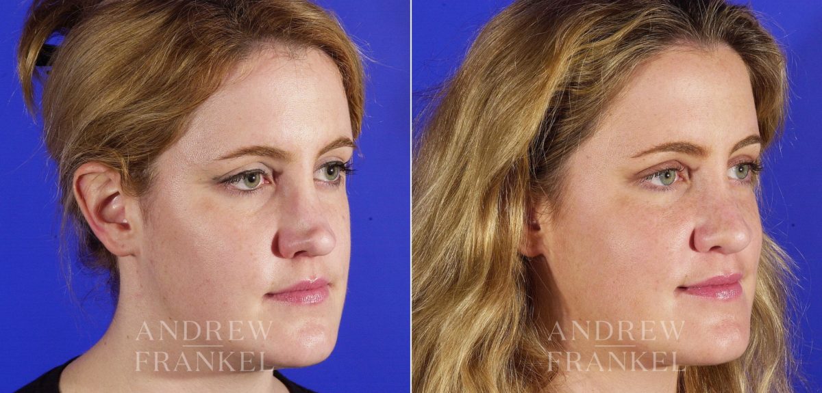 Revision Rhinoplasty before and after photos in Beverly Hills, CA, Patient 3714