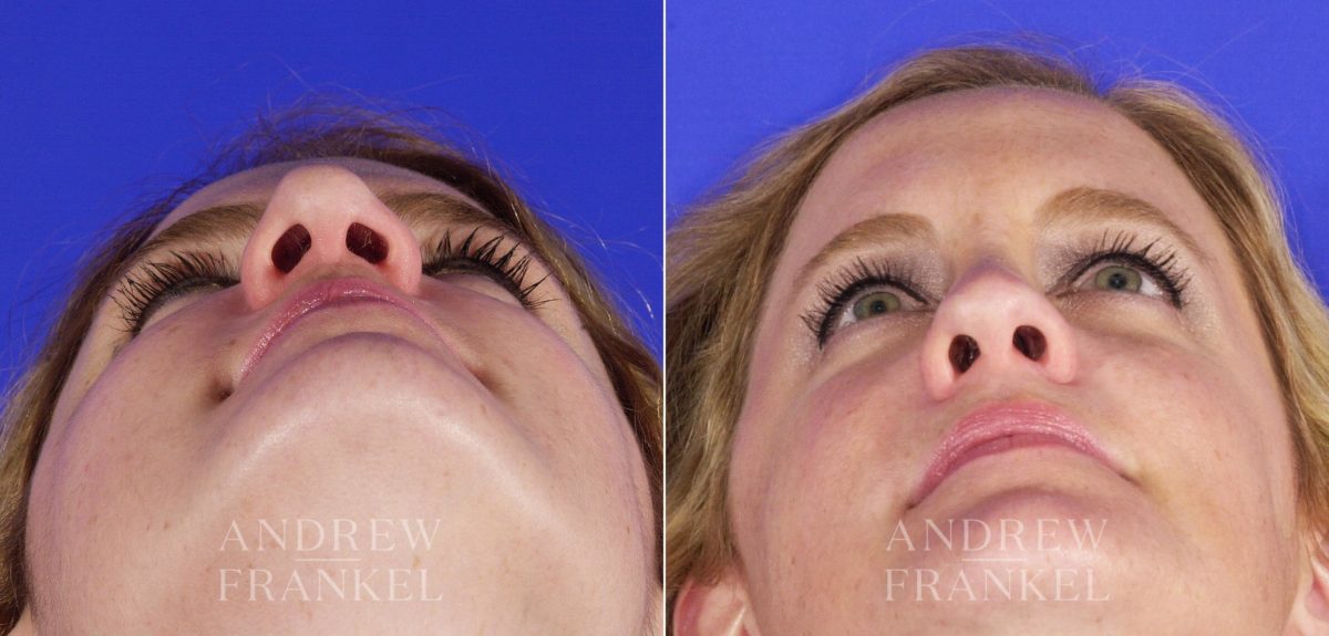 Revision Rhinoplasty before and after photos in Beverly Hills, CA, Patient 3714