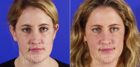 Revision Rhinoplasty before and after photos in Beverly Hills, CA, Patient 3714