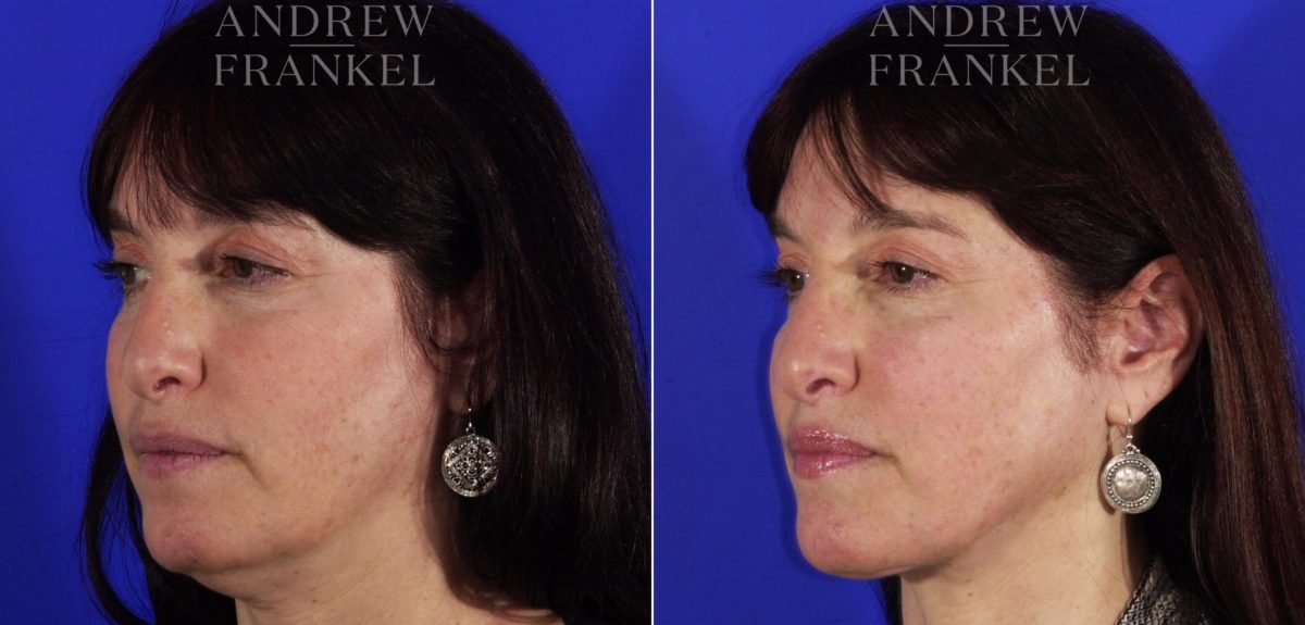 Neck Lift before and after photos in Beverly Hills, CA, Patient 3763