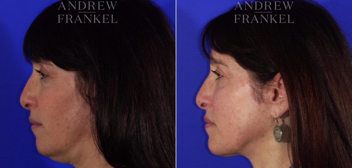 Neck Lift before and after photos in Beverly Hills, CA, Patient 3763