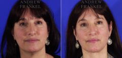 Neck Lift before and after photos in Beverly Hills, CA, Patient 3763