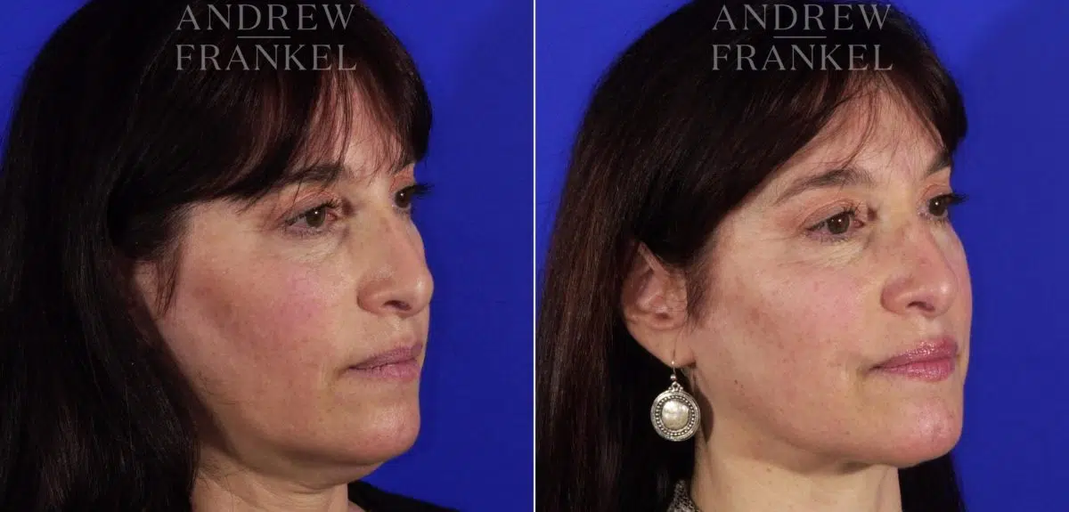 Neck Lift before and after photos in Beverly Hills, CA, Patient 3763