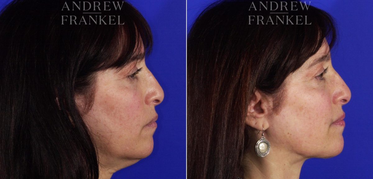 Neck Lift before and after photos in Beverly Hills, CA, Patient 3763