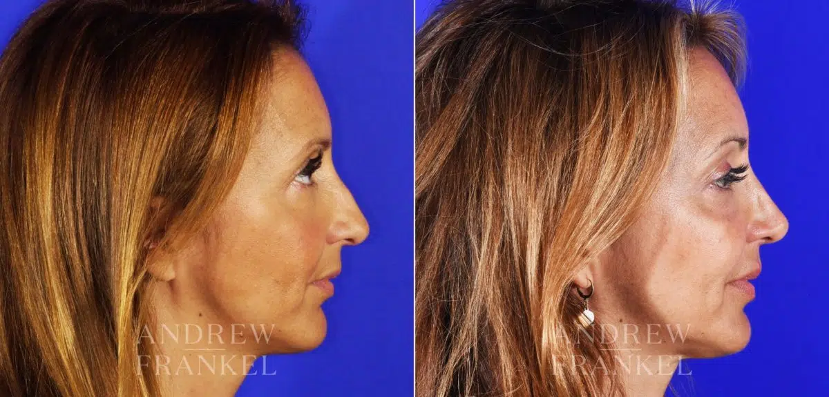 Revision Rhinoplasty before and after photos in Beverly Hills, CA, Patient 3793