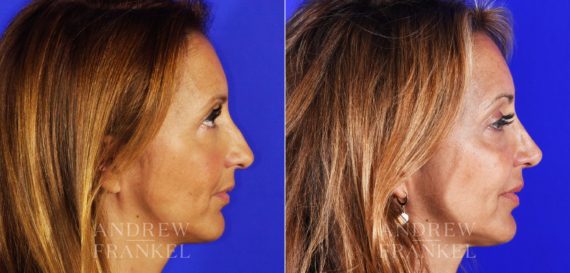 Revision Rhinoplasty before and after photos in Beverly Hills, CA, Patient 3793