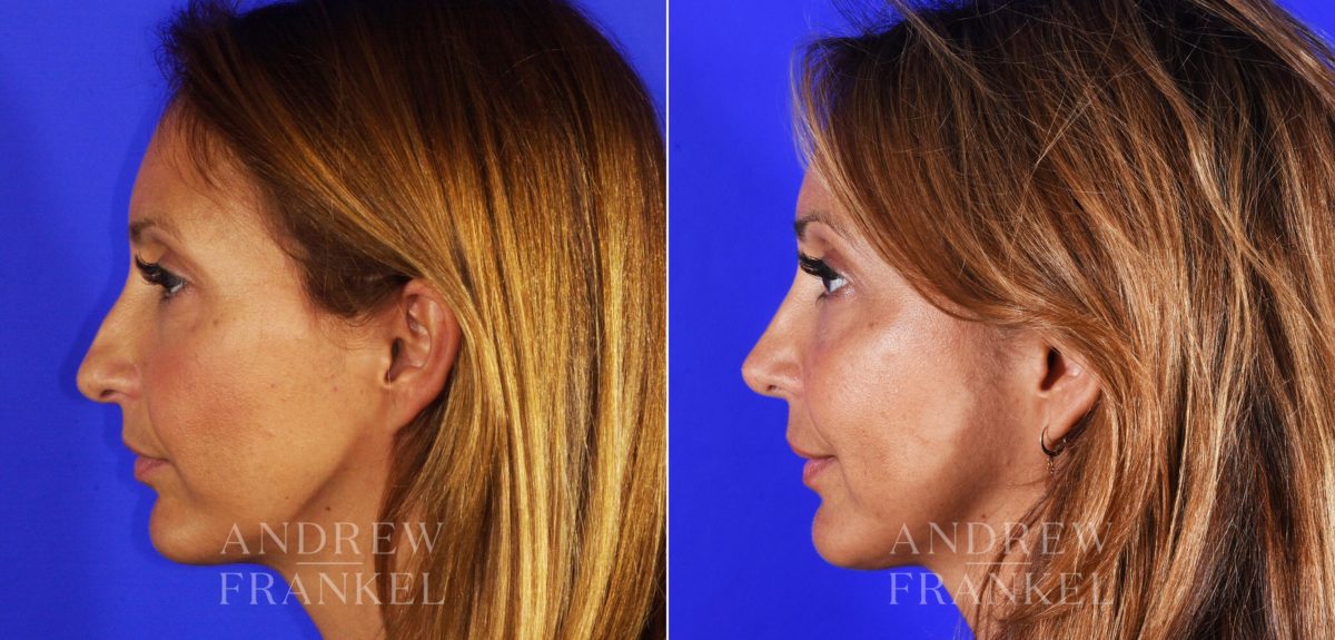 Revision Rhinoplasty before and after photos in Beverly Hills, CA, Patient 3793