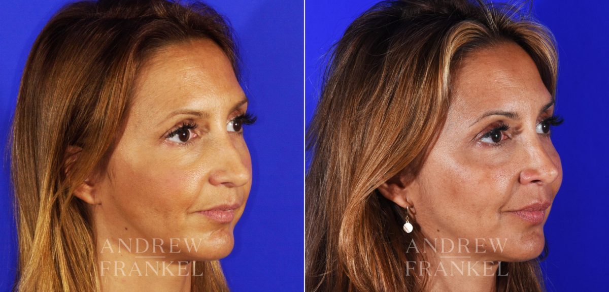 Revision Rhinoplasty before and after photos in Beverly Hills, CA, Patient 3793