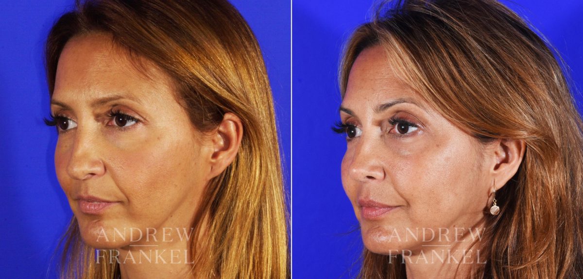 Revision Rhinoplasty before and after photos in Beverly Hills, CA, Patient 3793
