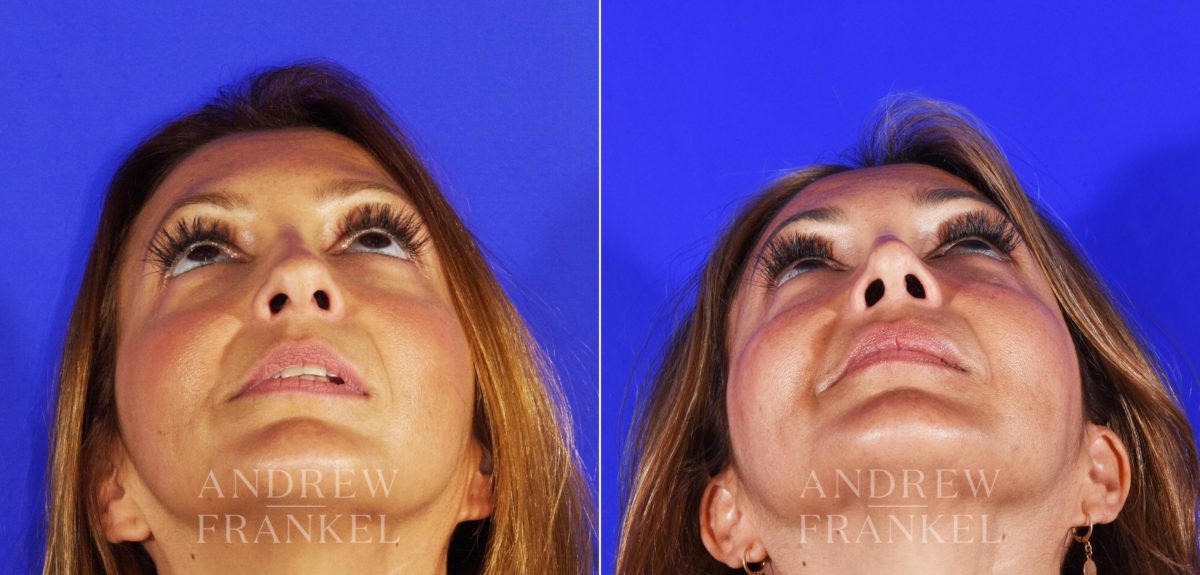 Revision Rhinoplasty before and after photos in Beverly Hills, CA, Patient 3793