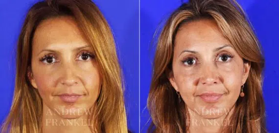Revision Rhinoplasty before and after photos in Beverly Hills, CA, Patient 3793