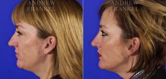 Jawline Contouring before and after photos in Beverly Hills, CA, Patient 3874