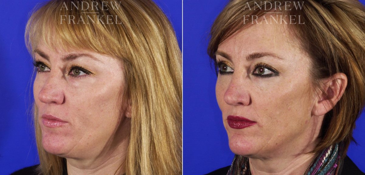 Jawline Contouring before and after photos in Beverly Hills, CA, Patient 3874