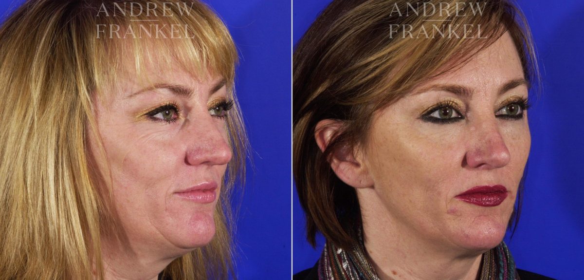 Jawline Contouring before and after photos in Beverly Hills, CA, Patient 3874