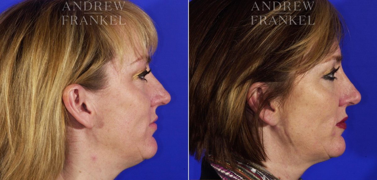 Jawline Contouring before and after photos in Beverly Hills, CA, Patient 3874