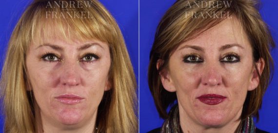 Jawline Contouring before and after photos in Beverly Hills, CA, Patient 3874