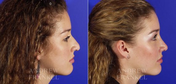 Revision Rhinoplasty before and after photos in Beverly Hills, CA, Patient 3887