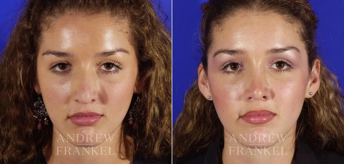 Revision Rhinoplasty before and after photos in Beverly Hills, CA, Patient 3887