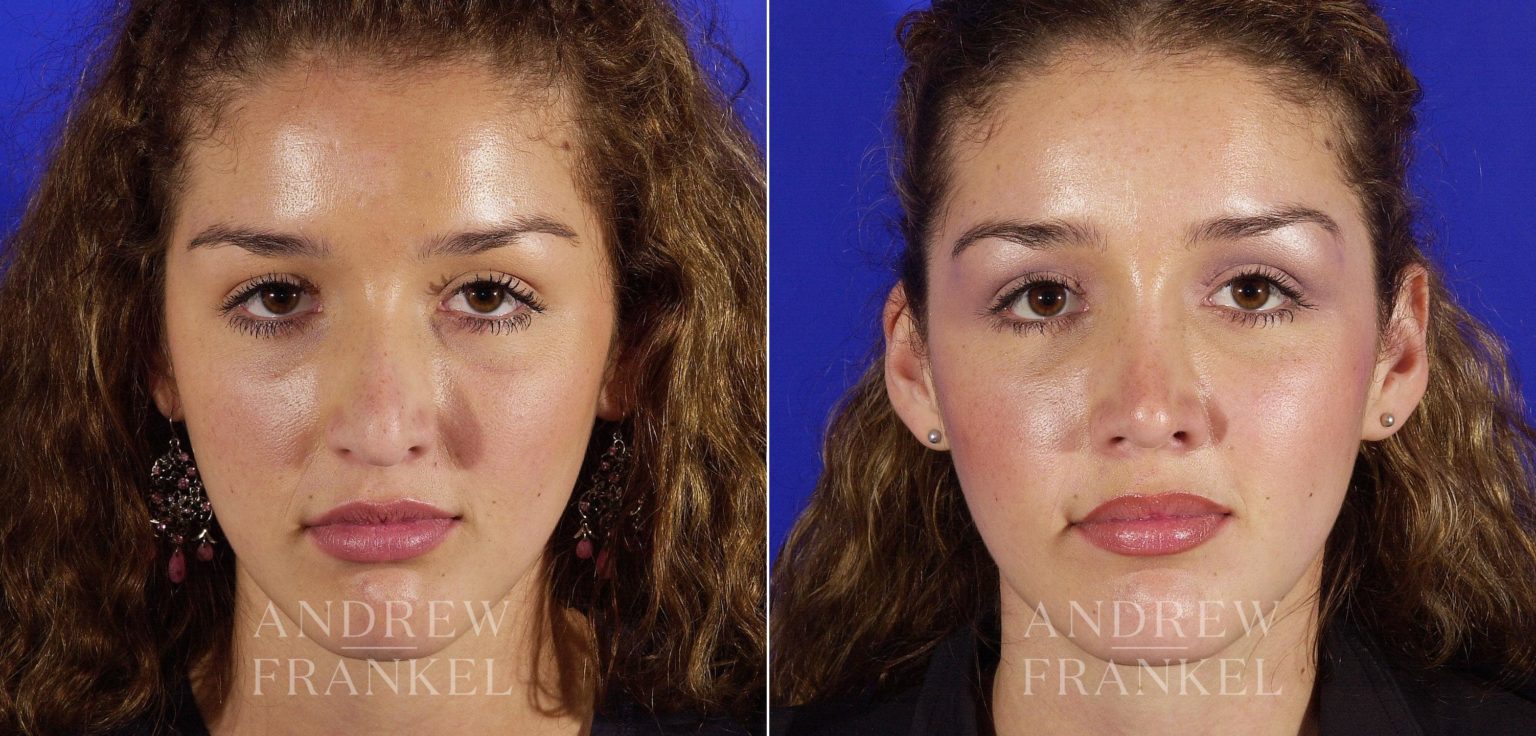 Revision Rhinoplasty before and after photos Andrew S. Frankel, MD