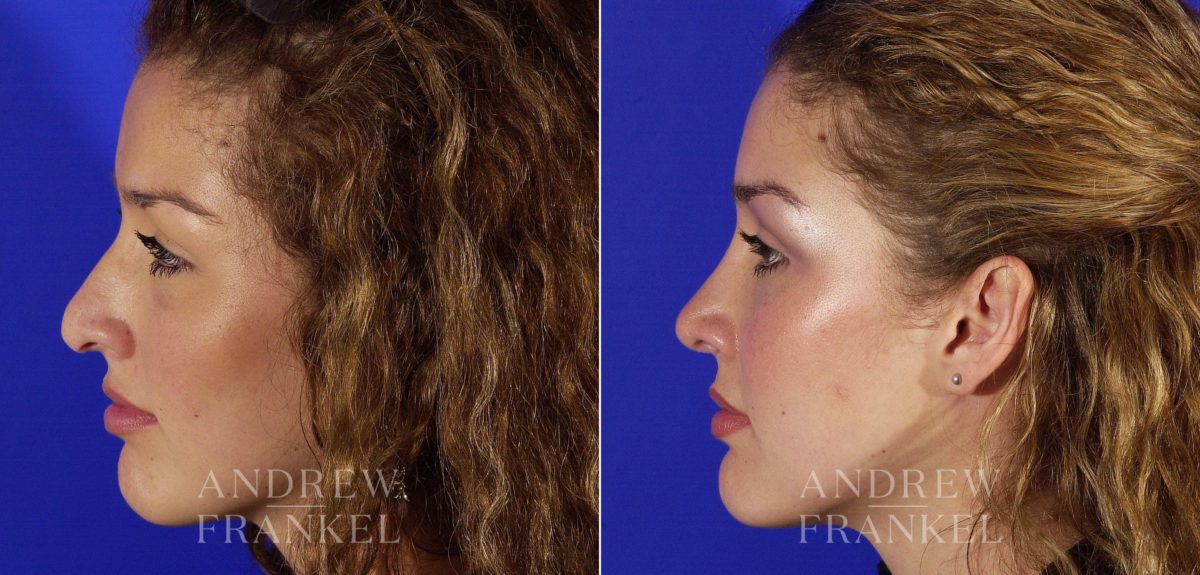 Revision Rhinoplasty before and after photos in Beverly Hills, CA, Patient 3887