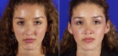 Revision Rhinoplasty before and after photos in Beverly Hills, CA, Patient 3887