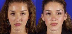 Revision Rhinoplasty before and after photos in Beverly Hills, CA, Patient 3887