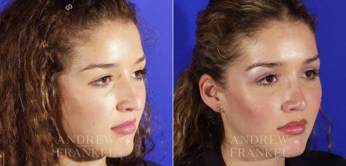 Revision Rhinoplasty before and after photos in Beverly Hills, CA, Patient 3887