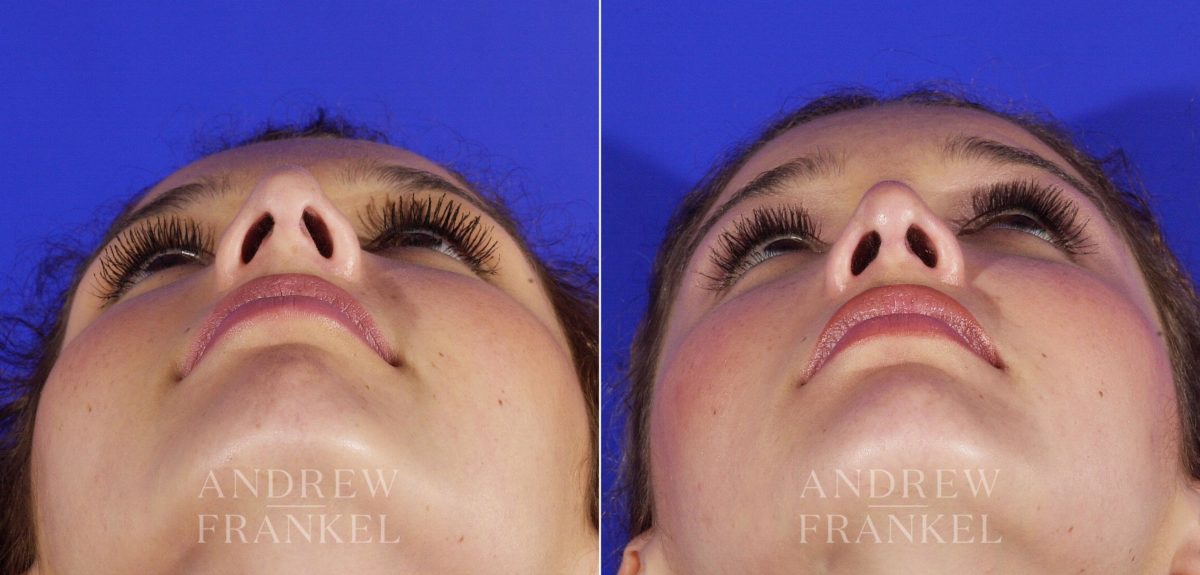 Revision Rhinoplasty before and after photos in Beverly Hills, CA, Patient 3887