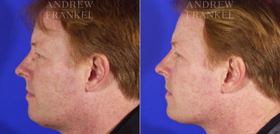 Jawline Contouring before and after photos in Beverly Hills, CA, Patient 3953