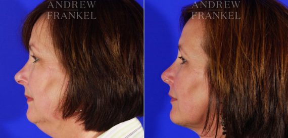 Jawline Contouring before and after photos in Beverly Hills, CA, Patient 3979