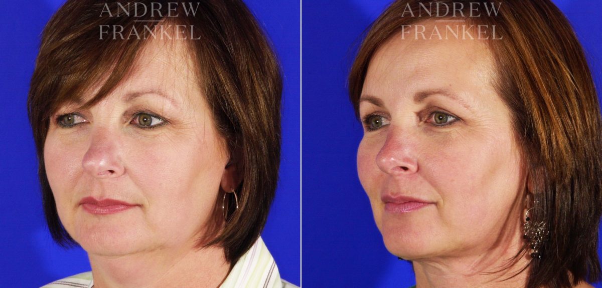 Jawline Contouring before and after photos in Beverly Hills, CA, Patient 3979