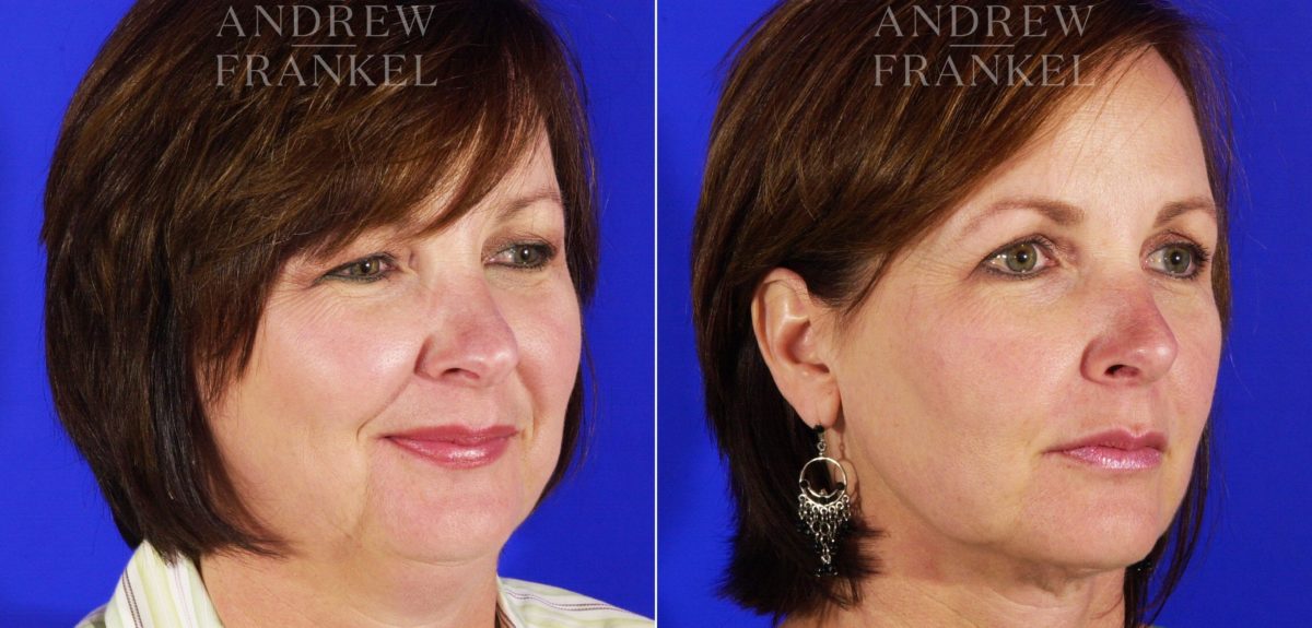 Jawline Contouring before and after photos in Beverly Hills, CA, Patient 3979